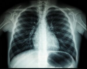 x ray image of chest cavity
