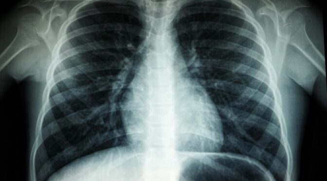 x ray image of chest cavity